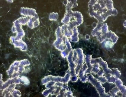severe rouleaux formations